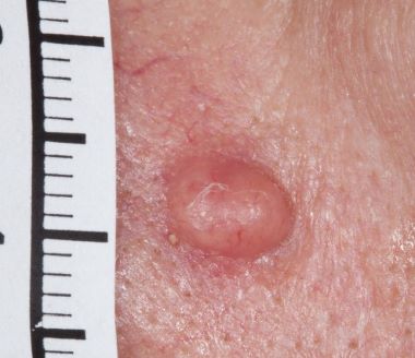 A close up photo of a skin coloured melanoma on fair skin, with a measuring tape beside it.