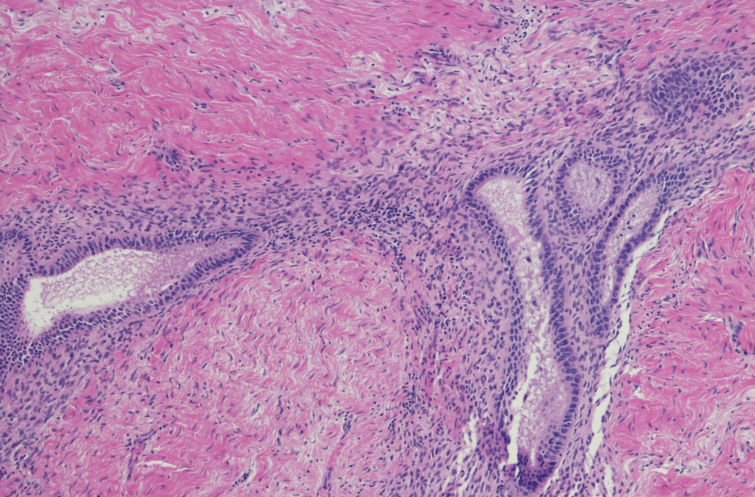 Microscope image of endometriosis