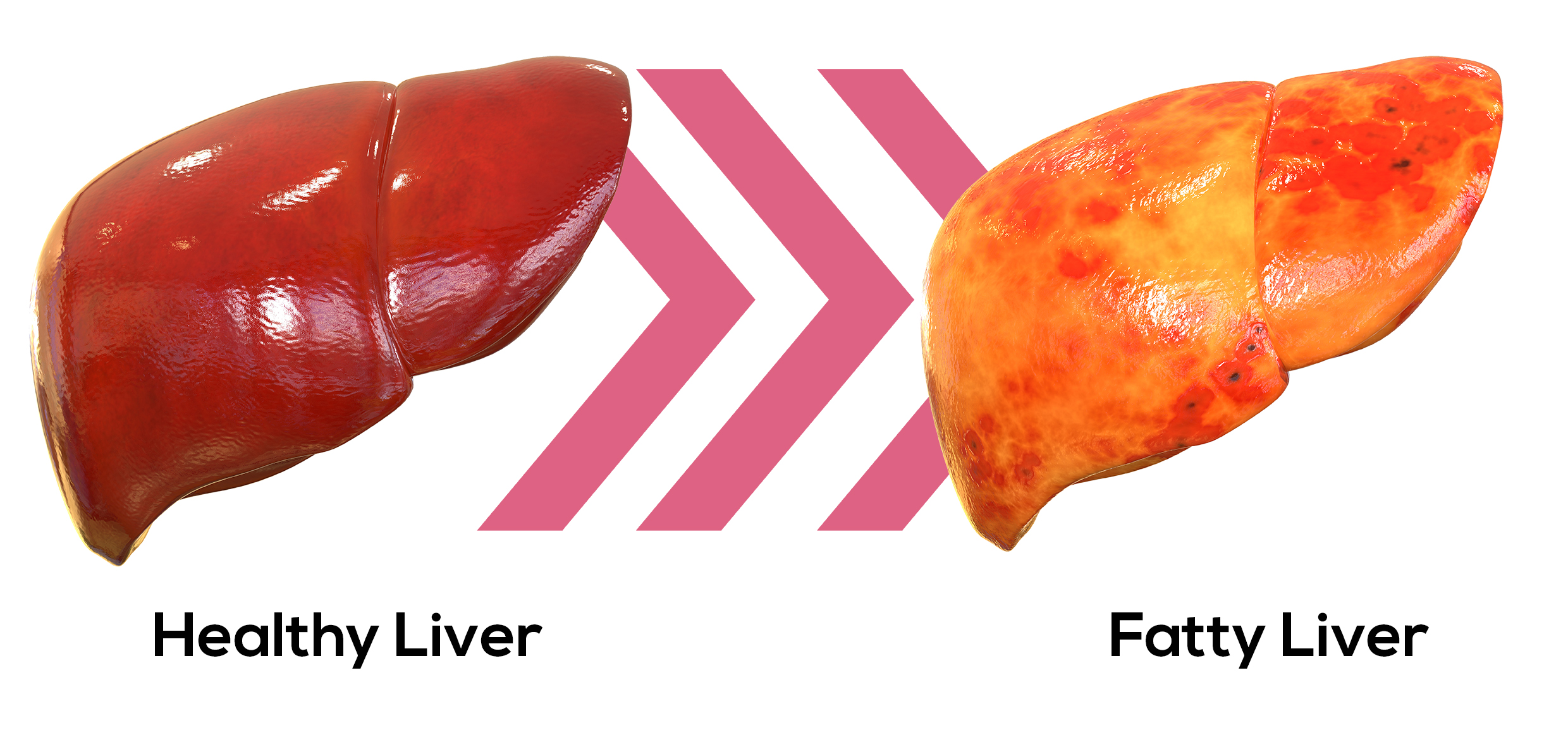 Unraveling non-alcoholic fatty liver disease - Faculty of Medicine -  University of Queensland