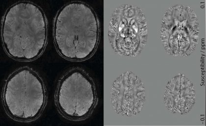 Accelerated MRI brain mapping technique to improve neurodegenerative diagnosis 