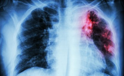 Scan-of-upper-body-showing-impact-of-tuberculosis-in-the-right-lung