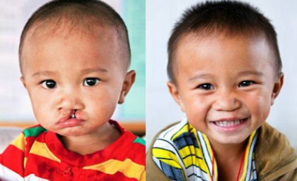 Bao, before and after cleft lip surgery at an Operation Smile medical mission.