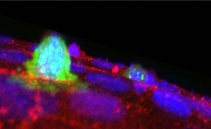 A potential cancer cell extruding from an epithelium. Courtesy of Selwin Wu, Yap Lab, UQ's Institute for Molecular Bioscience A potential cancer cell extruding from an epithelium. Courtesy of Selwin Wu, Yap Lab, UQ's Institute for Molecular Bioscience.