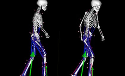 Researchers make ‘virtual’ changes to identify if particular treatments will improve a patient’s ability to move more freely