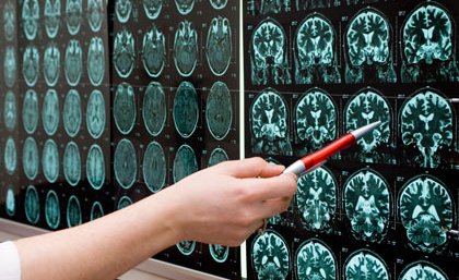 UQ scientists have found MRI’s could be used to predict Alzheimer’s disease.