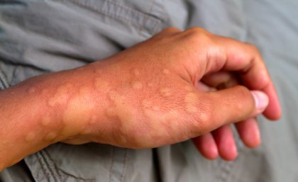 Severe skin rash is a symptom of a family of rare autoinflammatory diseases that can occur at birth and persist throughout life.