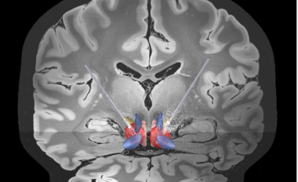 Electrodes implanted into the region of the brain involved in mediating sustained stress and anxiety