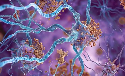 An illustration of the protein buildup on neurons that contributes to motor and cognitive symptoms. 