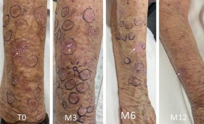 Photos of patient's forearm showing the decrease in lesions over a 12-month period. 
