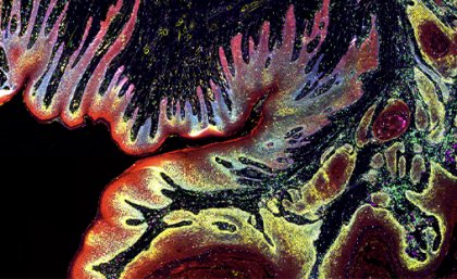 A digital image of a skin cancer by Associate Professor Arutha Kulasinghe, which won the NHMRC Science to Art Award. A digital image of a skin cancer located in the head and neck. The skin cells are shown in bright red, with the tumour pockets in dull red surrounded by yellow. Immune cells are patrolling the tissue in green and magenta.