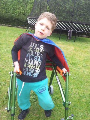 Ashton “Little Superman” Hancock, has hypoplasia of the corpus callosum, resulting in epilepsy and hearing impairment