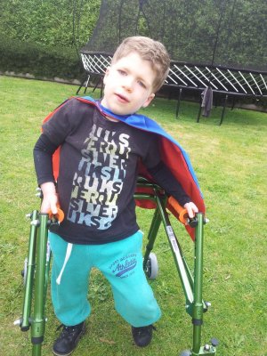 Ashton “Little Superman” Hancock, has hypoplasia of the corpus callosum, resulting in epilepsy and hearing impairment Ashton “Little Superman” Hancock, has hypoplasia of the corpus callosum, resulting in epilepsy and hearing impairment