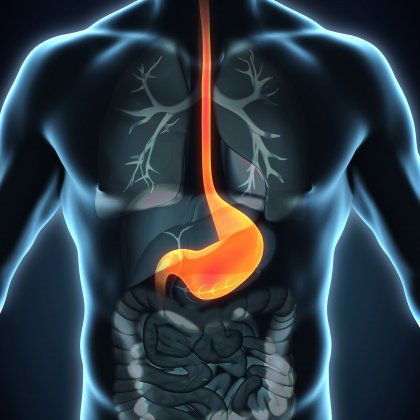 The incidence of oesophagael cancer is increasing, particularly among obese men with reflux (heartburn) and a history of smoking. The incidence of oesophagael cancer is increasing, particularly among obese men with reflux (heartburn) and a history of smoking.