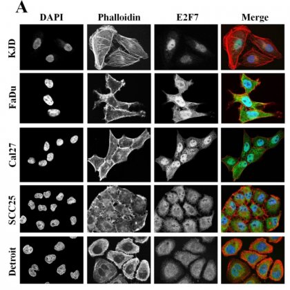 Green colour shows E2F7 that has leaked out of the nucleus in drug resistant cancer cells.