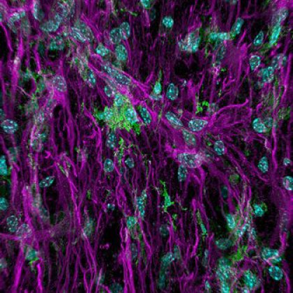 Inflammation after spinal cord injury. Image source: Ms Faith Brennan (UQ School of Biomedical Sciences) and Mr Luke Hammond (UQ Queensland Brain Institute). Inflammation after spinal cord injury. Image source: Ms Faith Brennan (UQ School of Biomedical Sciences) and Mr Luke Hammond (UQ Queensland Brain Institute).