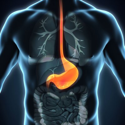 The incidence of oesophagael cancer is increasing, particularly among obese men with reflux (heartburn) and a history of smoking.