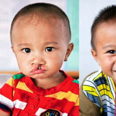 Bao, before and after cleft lip surgery at an Operation Smile medical mission.