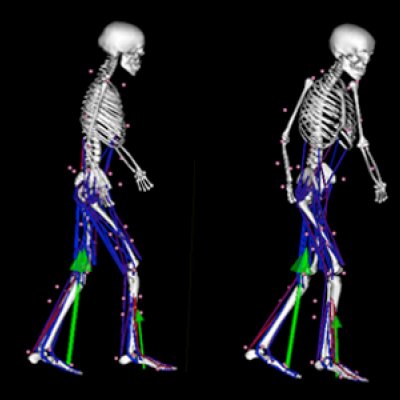 Researchers make ‘virtual’ changes to identify if particular treatments will improve a patient’s ability to move more freely