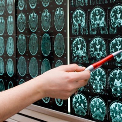 UQ scientists have found MRI’s could be used to predict Alzheimer’s disease.