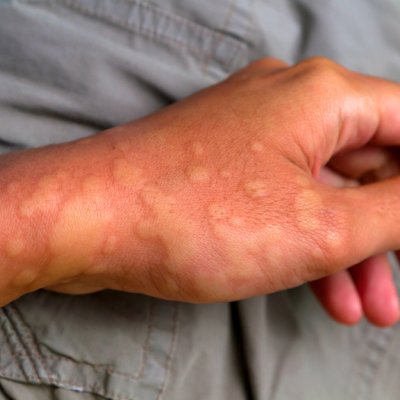 Severe skin rash is a symptom of a family of rare autoinflammatory diseases that can occur at birth and persist throughout life.