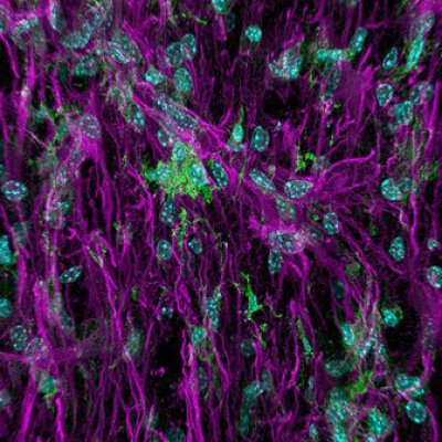 Inflammation after spinal cord injury. Image source: Ms Faith Brennan (UQ School of Biomedical Sciences) and Mr Luke Hammond (UQ Queensland Brain Institute).