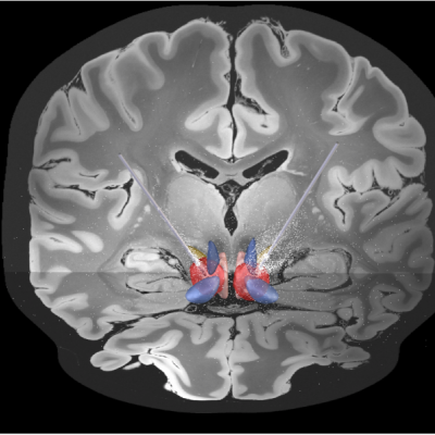 Electrodes implanted into the region of the brain involved in mediating sustained stress and anxiety