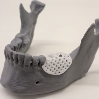 A model jaw covered by a small latticed 3d-printed cover 