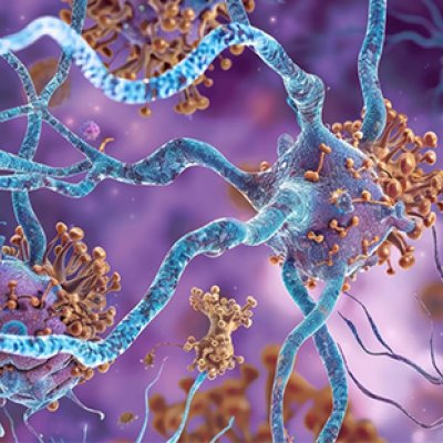 An illustration of the protein buildup on neurons that contributes to motor and cognitive symptoms. 