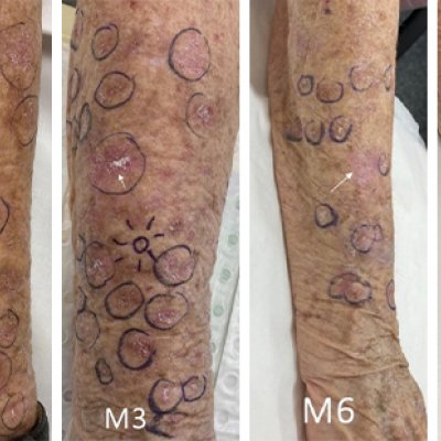 Photos of patient's forearm showing the decrease in lesions over a 12-month period. 