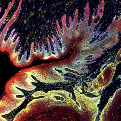 A digital image of a skin cancer located in the head and neck. The skin cells are shown in bright red, with the tumour pockets in dull red surrounded by yellow. Immune cells are patrolling the tissue in green and magenta.