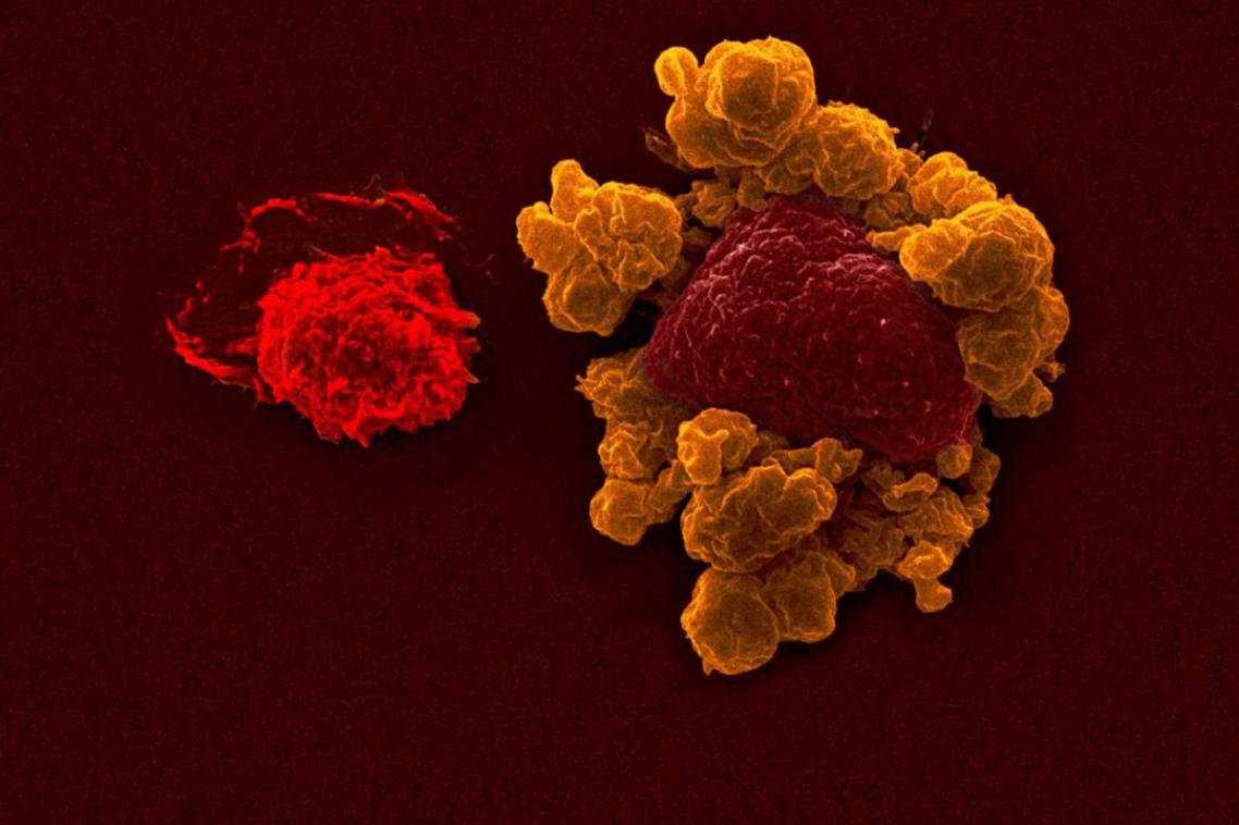 An electron microscope image showing a tumour cell breaking up and dying after being attacked by a natural killer cell.